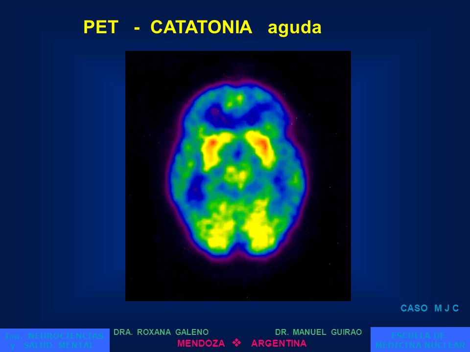 PET - CATATONIA aguda CASO M J C ESCUELA DE MENDOZA v ARGENTINA