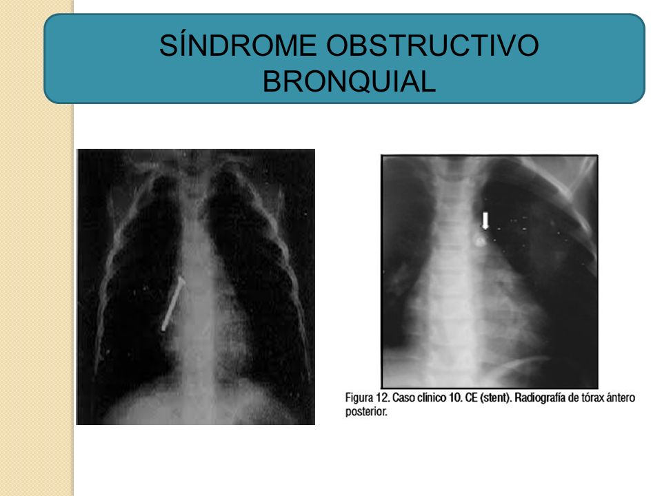 SÍNDROME OBSTRUCTIVO BRONQUIAL