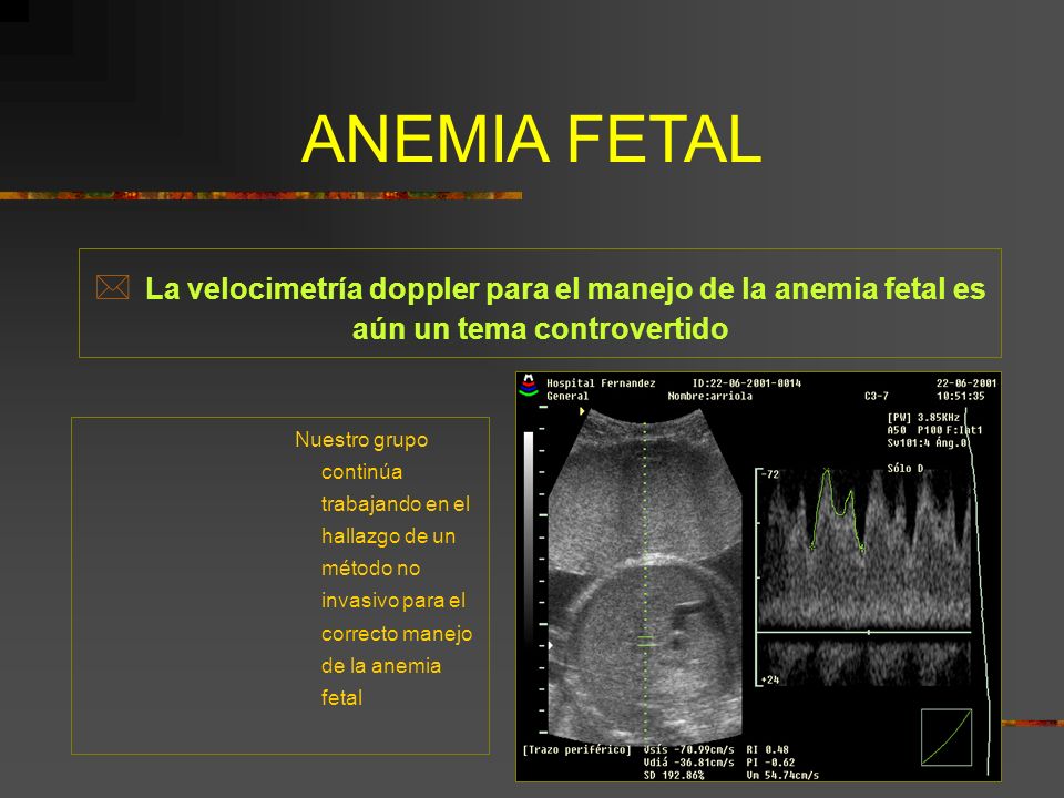 ANEMIA FETAL La velocimetría doppler para el manejo de la anemia fetal es aún un tema controvertido.
