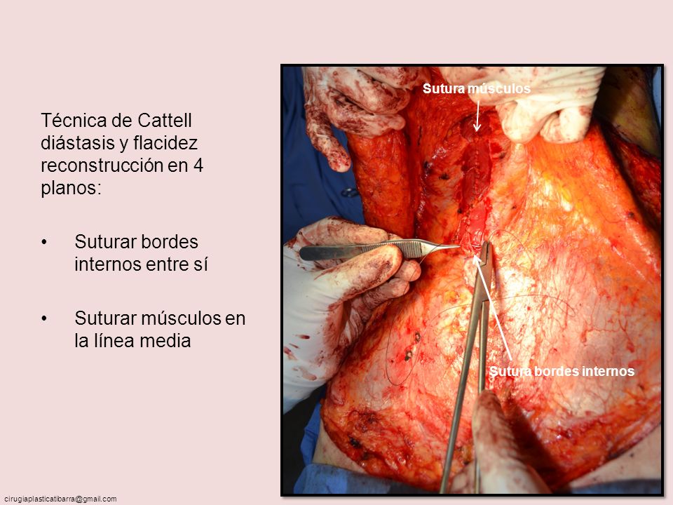 Técnica de Cattell diástasis y flacidez reconstrucción en 4 planos: