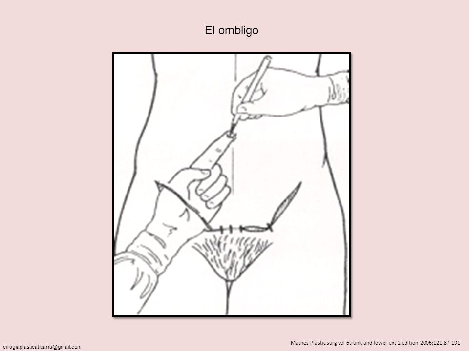 El ombligo Mathes Plastic surg vol 6trunk and lower ext 2 edition 2006;121: