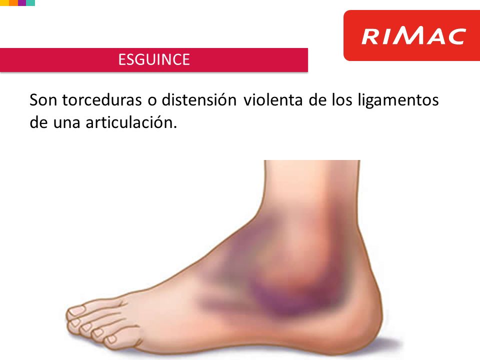 ESGUINCE Son torceduras o distensión violenta de los ligamentos de una articulación.