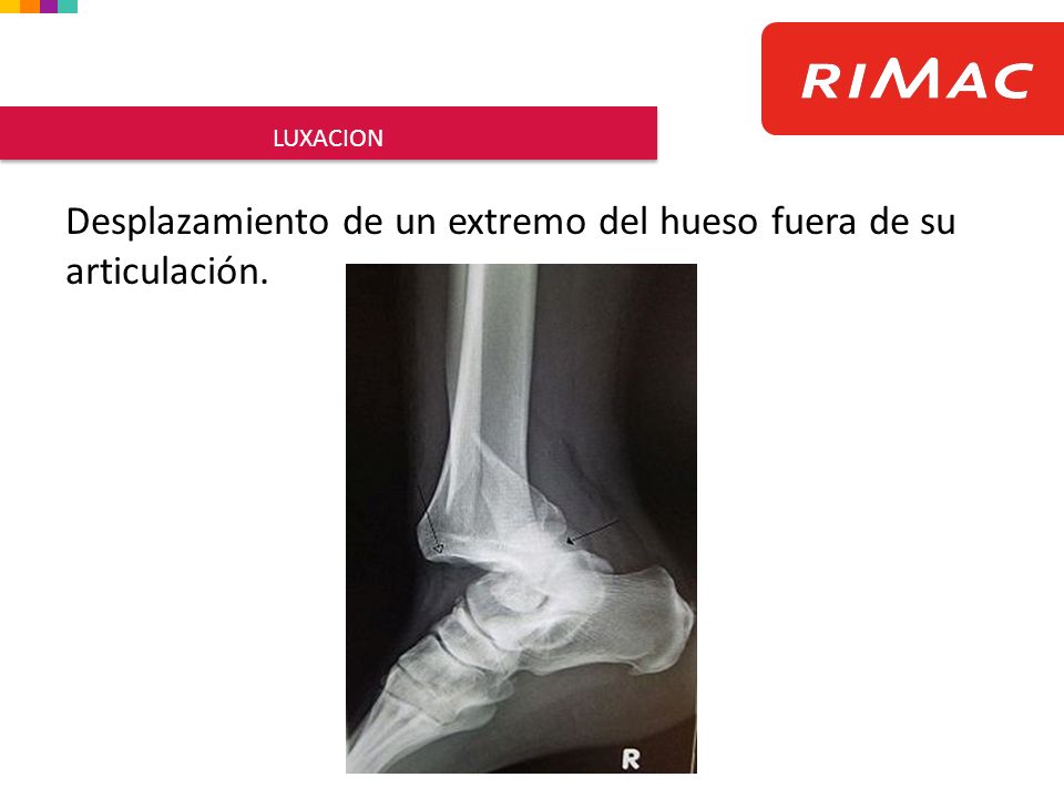 Desplazamiento de un extremo del hueso fuera de su articulación.