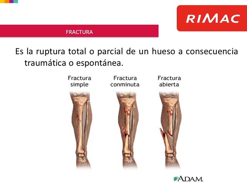 FRACTURA Es la ruptura total o parcial de un hueso a consecuencia traumática o espontánea.