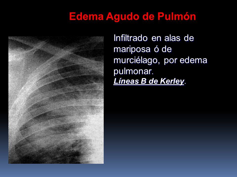 Edema Agudo de Pulmón Infiltrado en alas de mariposa ó de murciélago, por edema pulmonar.