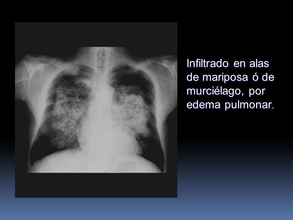 Infiltrado en alas de mariposa ó de murciélago, por edema pulmonar.