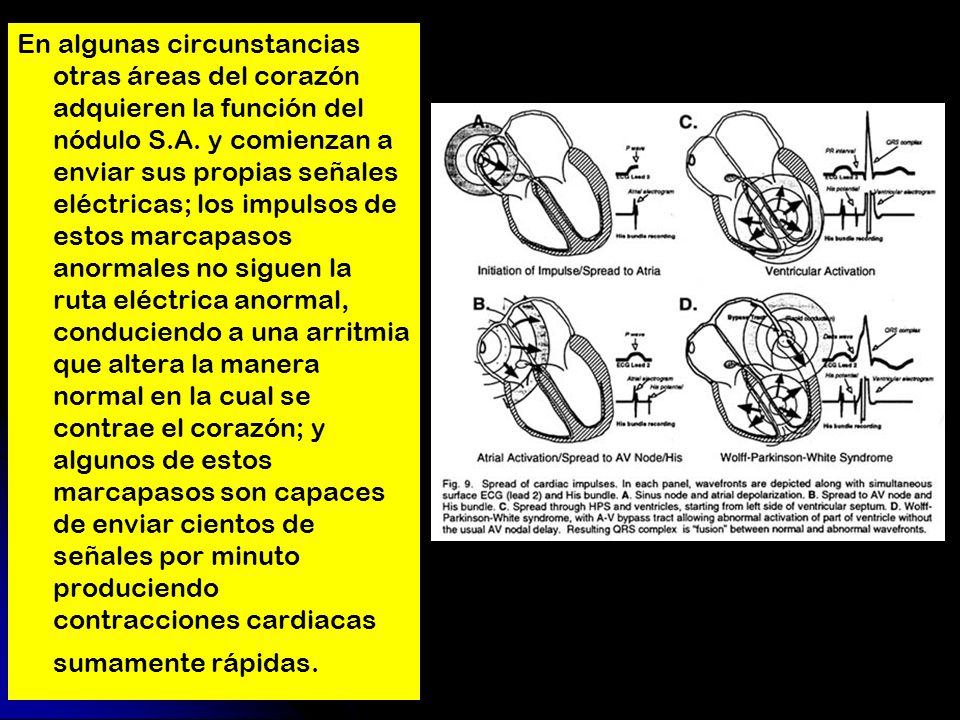 En algunas circunstancias otras áreas del corazón adquieren la función del nódulo S.A.