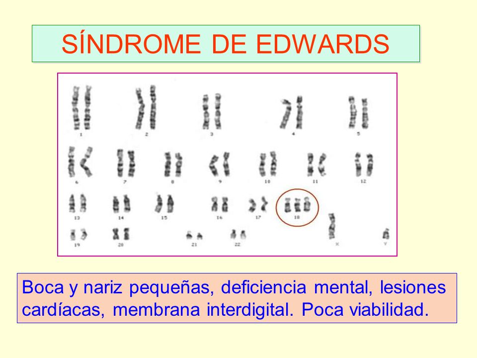 SÍNDROME DE EDWARDS Boca y nariz pequeñas, deficiencia mental, lesiones cardíacas, membrana interdigital.