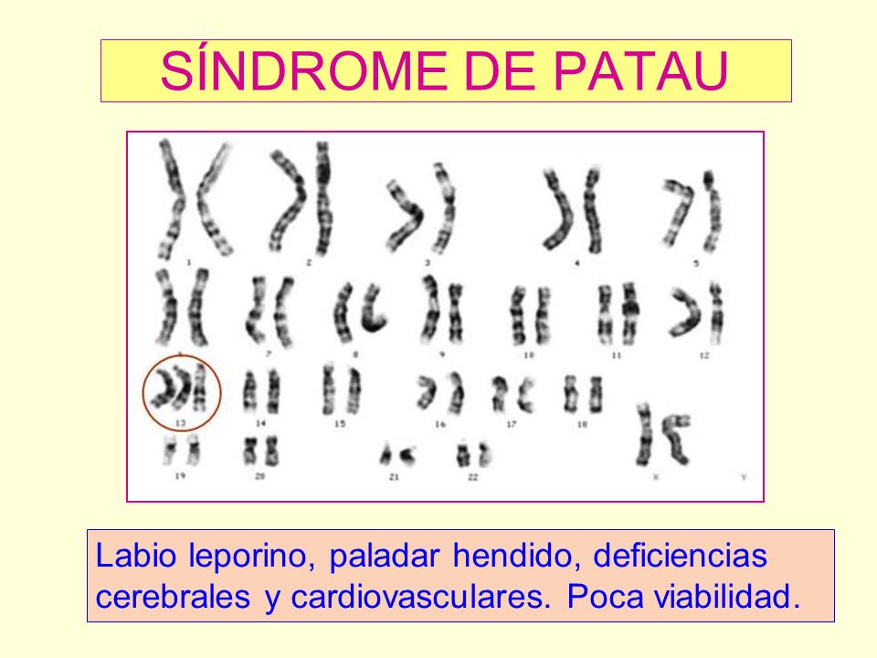 SÍNDROME DE PATAU Labio leporino, paladar hendido, deficiencias cerebrales y cardiovasculares.