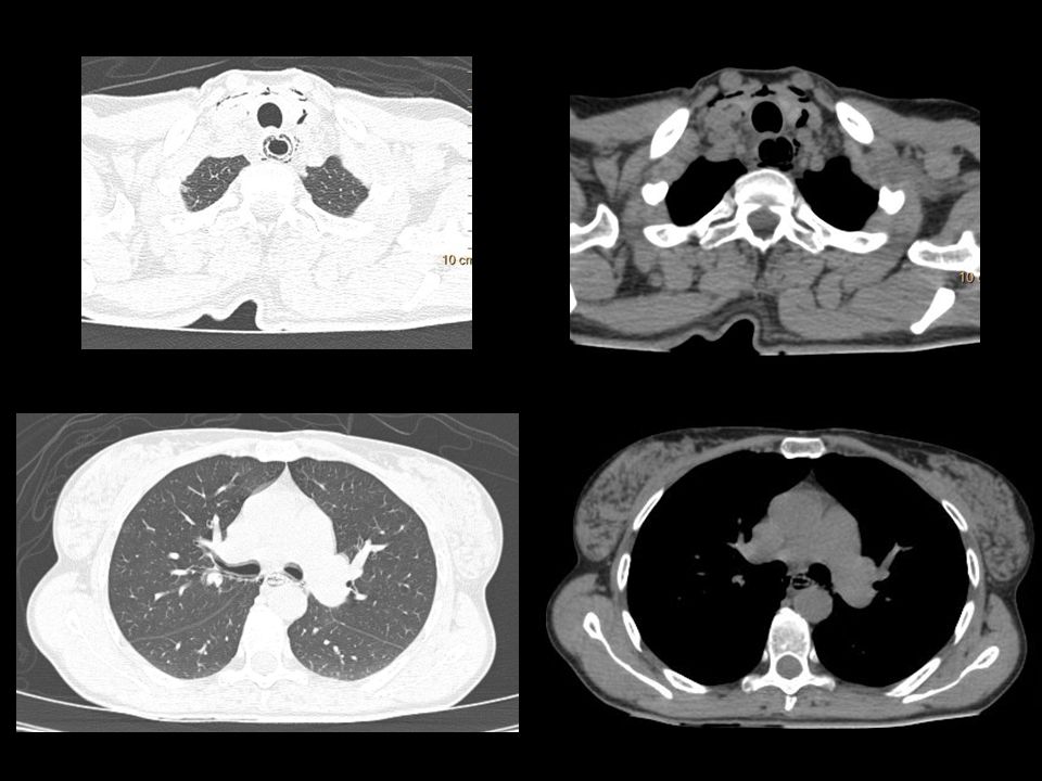 enfisema en planos profundo y medio a nivel del cuello este se continúa hacia mediastino posterior en particular peri esofágico.