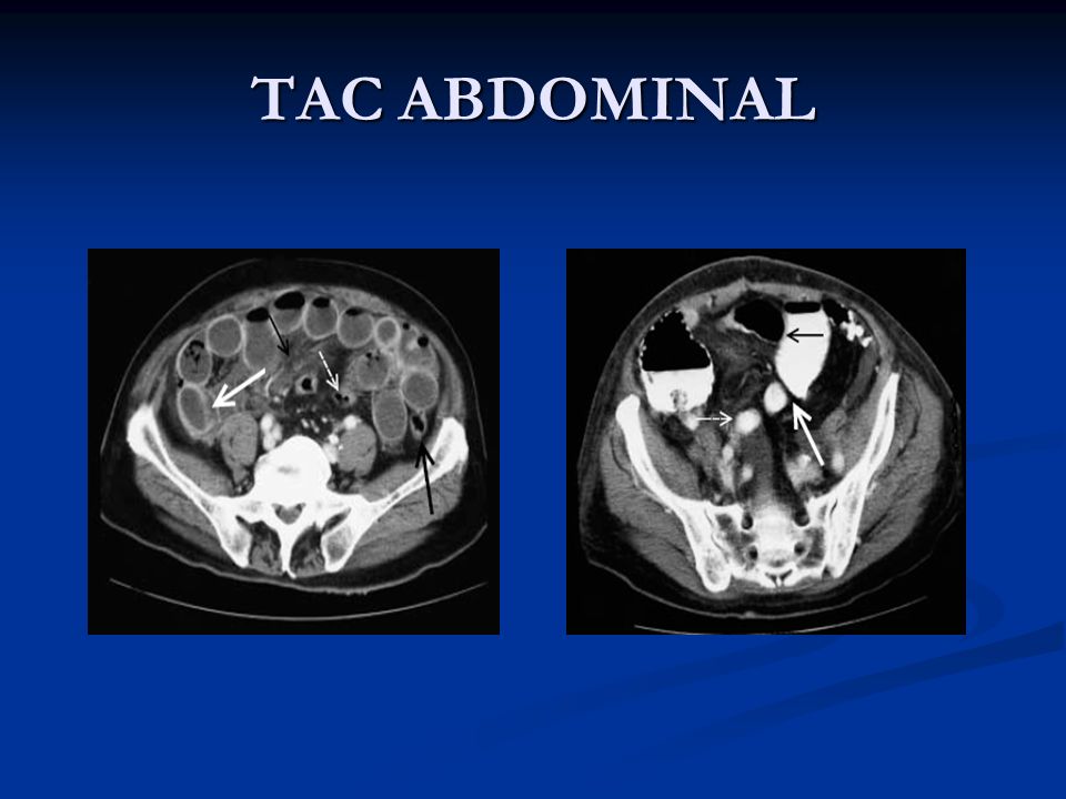 TAC ABDOMINAL