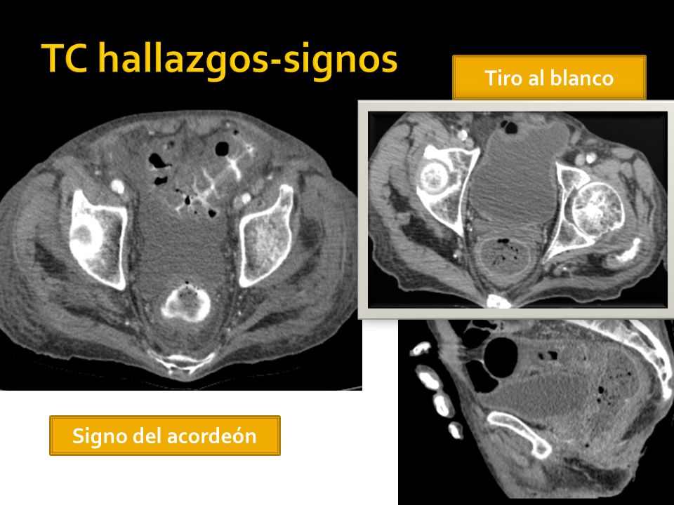 TC hallazgos-signos Tiro al blanco Signo del acordeón