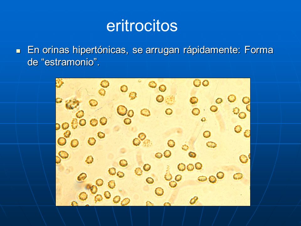 eritrocitos En orinas hipertónicas, se arrugan rápidamente: Forma de estramonio .