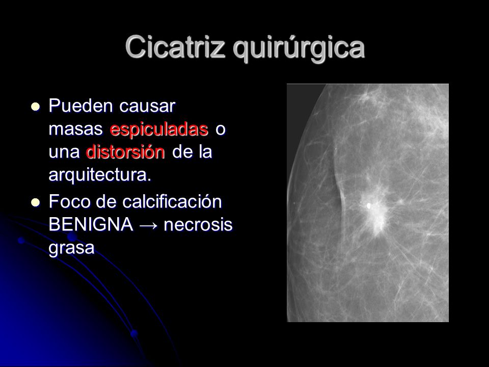 Cicatriz quirúrgica Pueden causar masas espiculadas o una distorsión de la arquitectura.