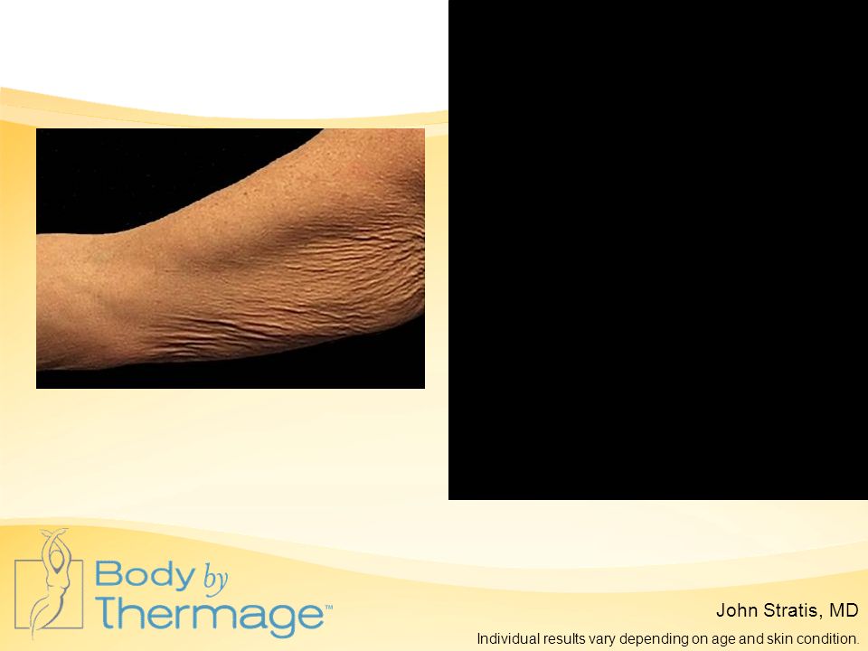 Before Thermage 3 Months Post Thermage John Stratis, MD