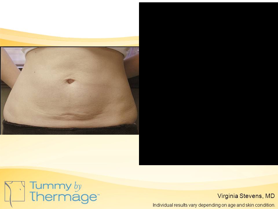 Before Thermage 18 Months Post Thermage Virginia Stevens, MD