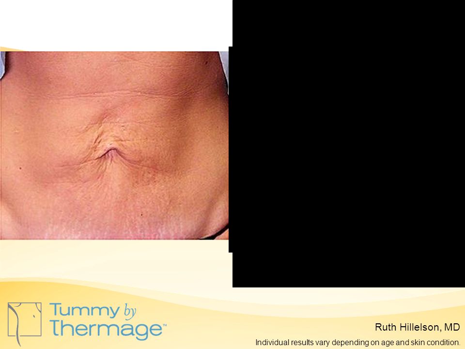 Before Thermage 5 Months Post Thermage Ruth Hillelson, MD