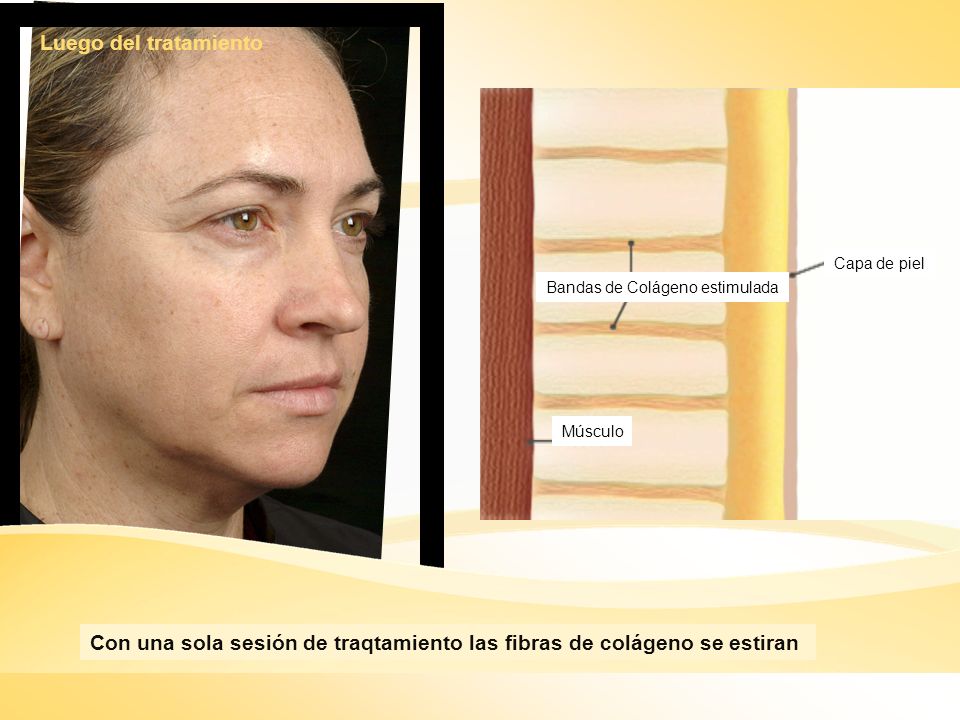 Con una sola sesión de traqtamiento las fibras de colágeno se estiran