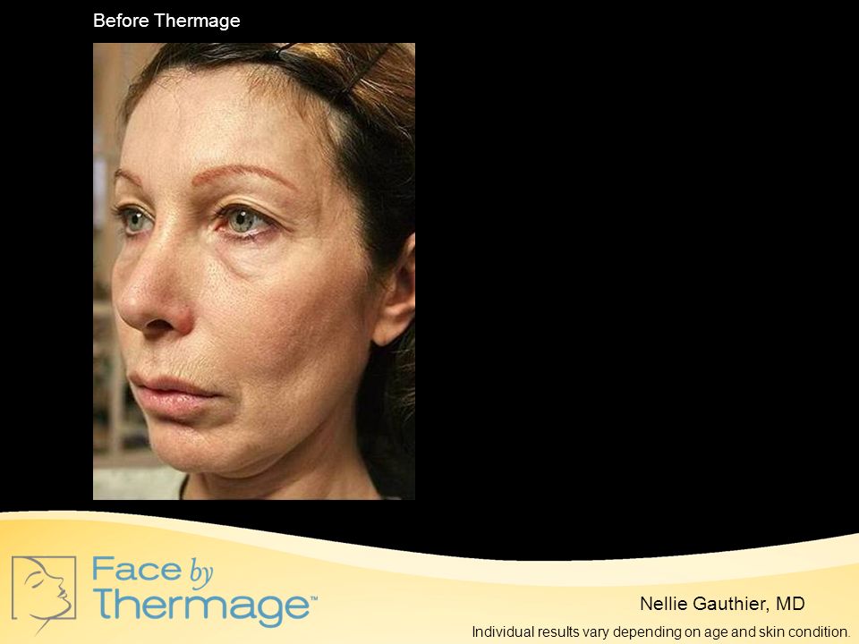 Before Thermage 10 Months Post Thermage Nellie Gauthier, MD