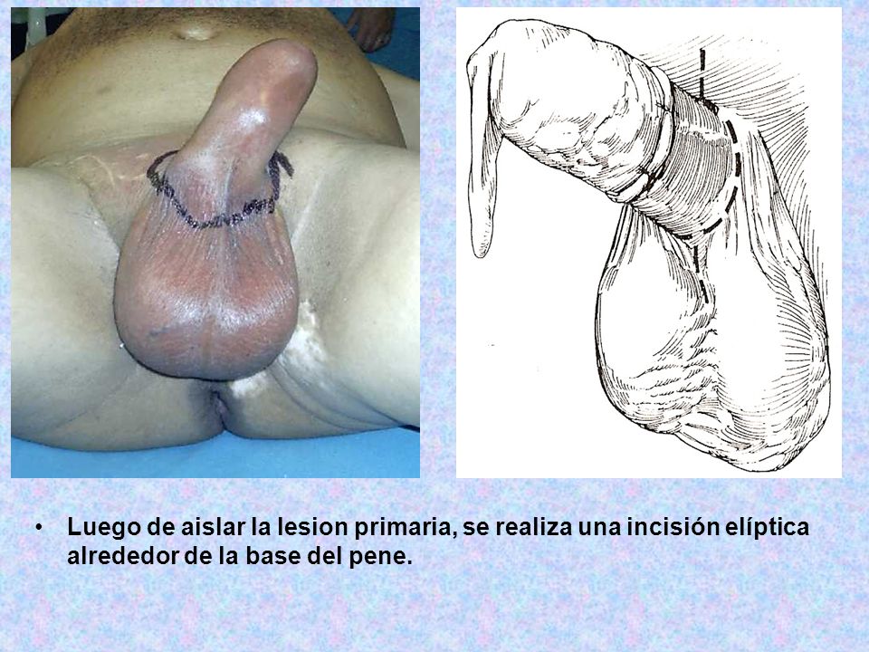 Luego de aislar la lesion primaria, se realiza una incisión elíptica alrededor de la base del pene.