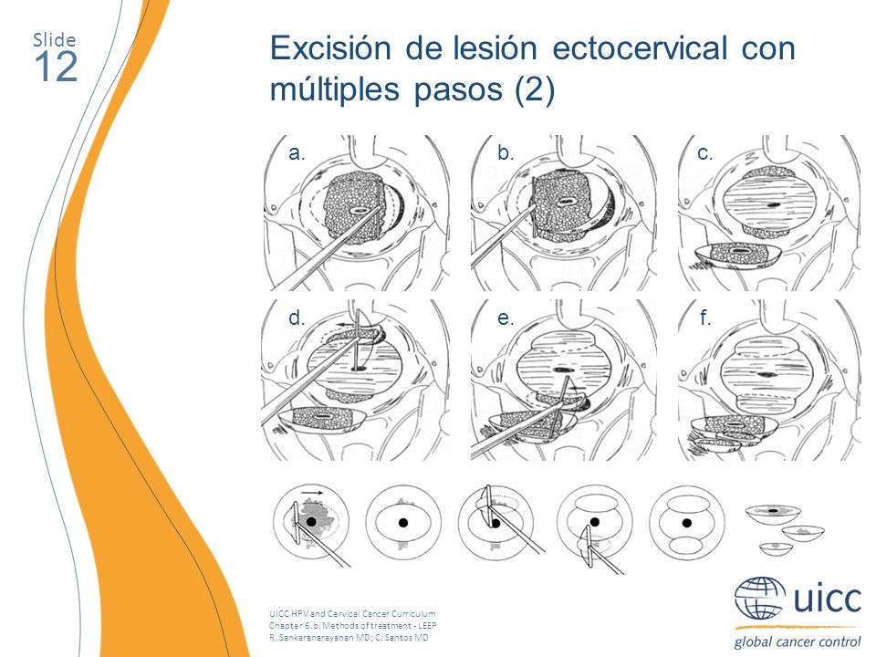 12 Excisión de lesión ectocervical con múltiples pasos (2) Slide a. b.