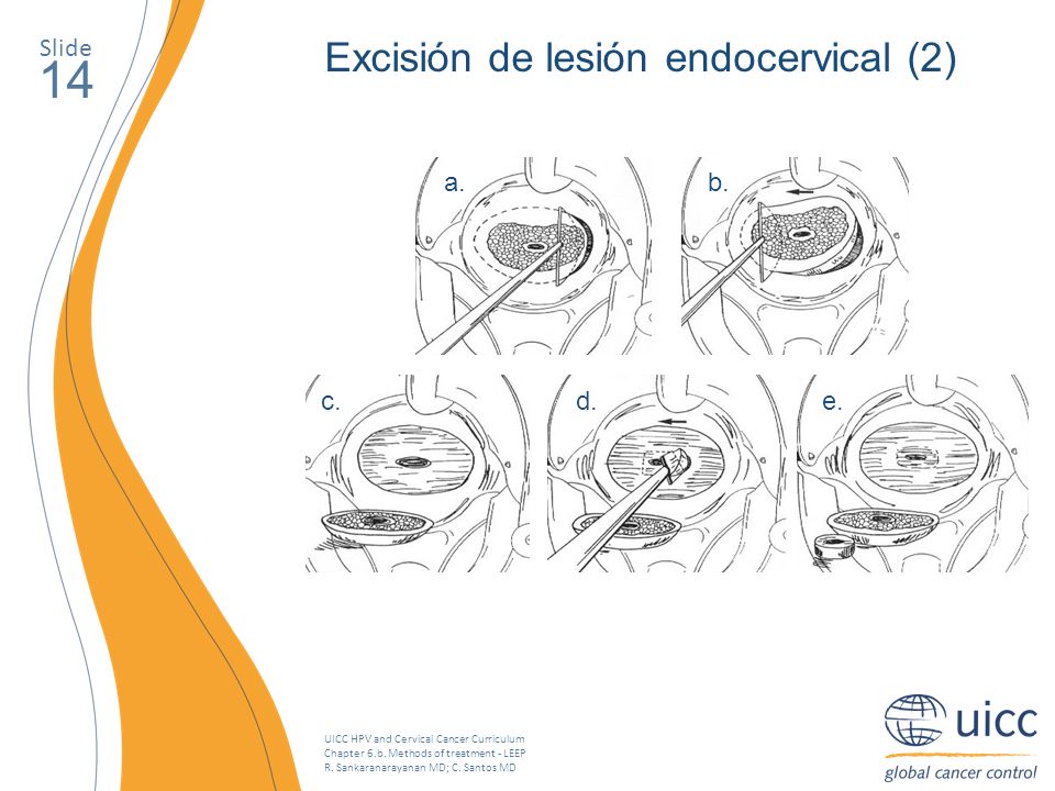 14 Excisión de lesión endocervical (2) Slide a. b. c. d. e.