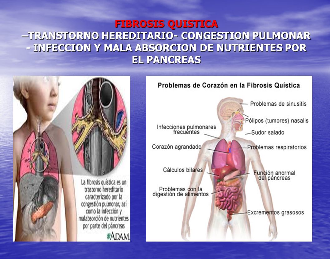 FIBROSIS QUISTICA –TRANSTORNO HEREDITARIO- CONGESTION PULMONAR - INFECCION Y MALA ABSORCION DE NUTRIENTES POR EL PANCREAS