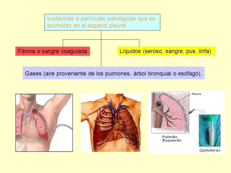 Gases (aire proveniente de los pulmones, árbol bronquial o esófago).