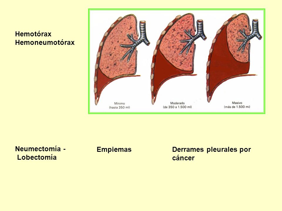 Hemotórax Hemoneumotórax Neumectomía - Lobectomía Empiemas Derrames pleurales por cáncer