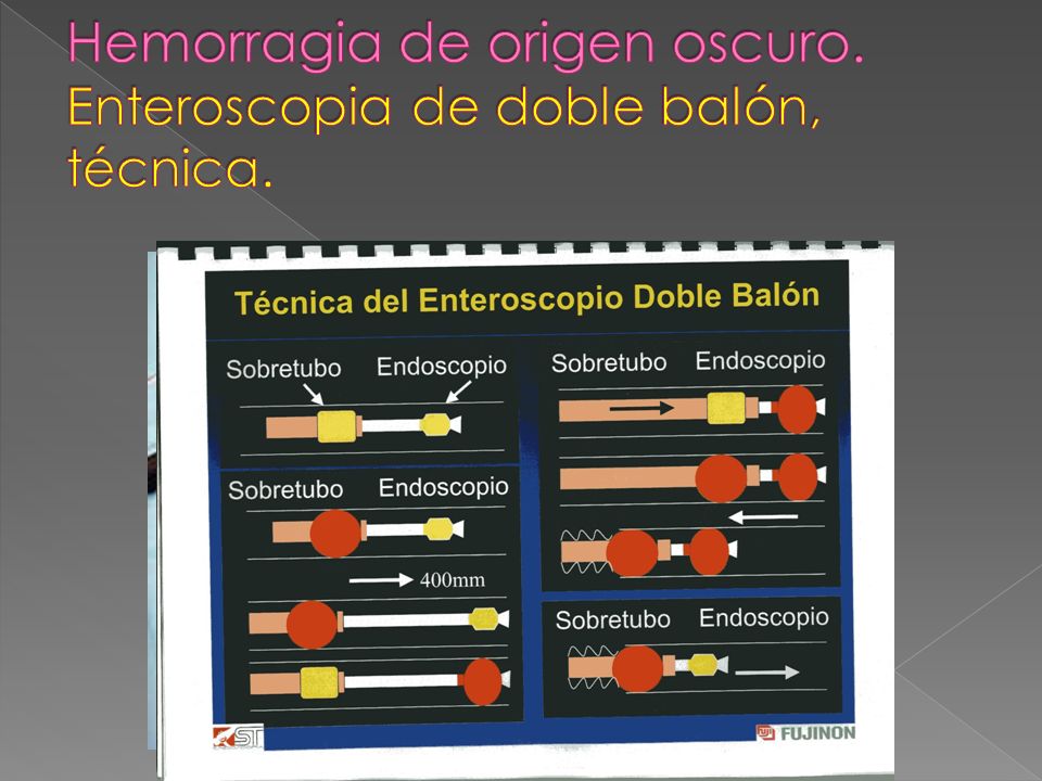 Hemorragia de origen oscuro. Enteroscopia de doble balón, técnica.