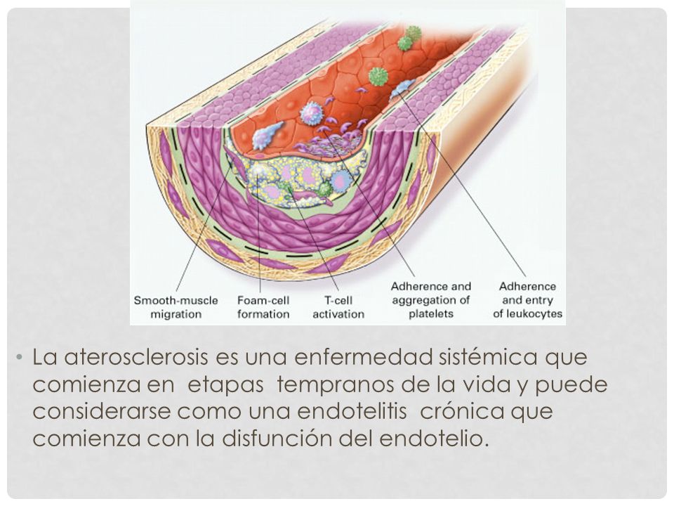 La aterosclerosis es una enfermedad sistémica que comienza en etapas tempranos de la vida y puede considerarse como una endotelitis crónica que comienza con la disfunción del endotelio.
