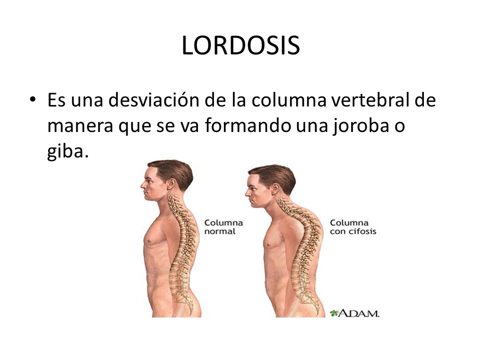 LORDOSIS Es una desviación de la columna vertebral de manera que se va formando una joroba o giba.