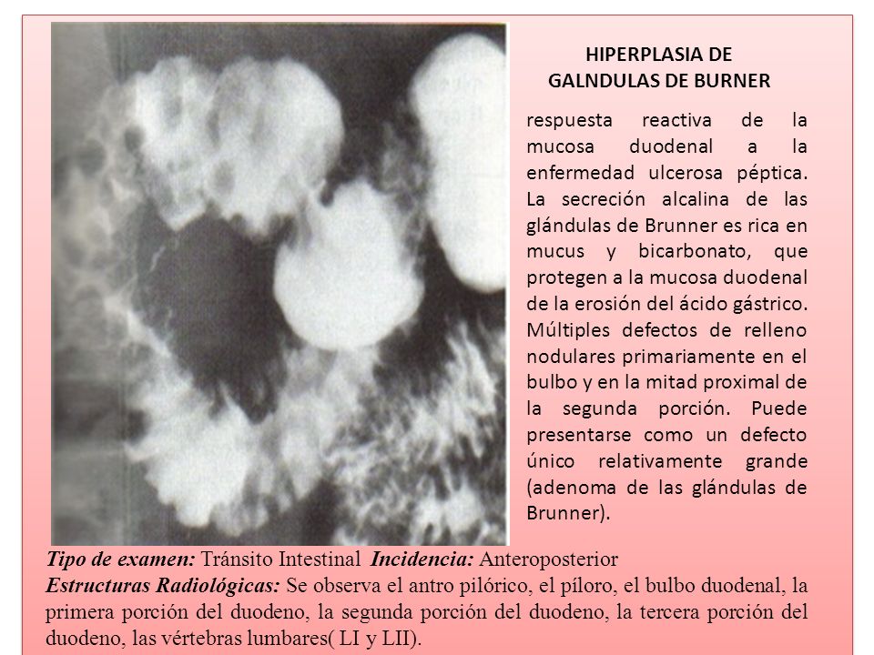 HIPERPLASIA DE GALNDULAS DE BURNER