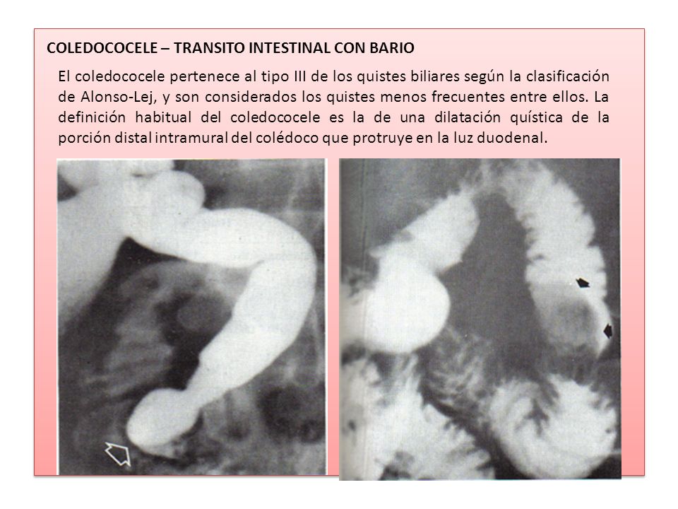 COLEDOCOCELE – TRANSITO INTESTINAL CON BARIO
