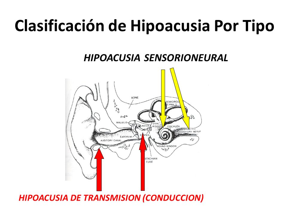 Clasificación de Hipoacusia Por Tipo