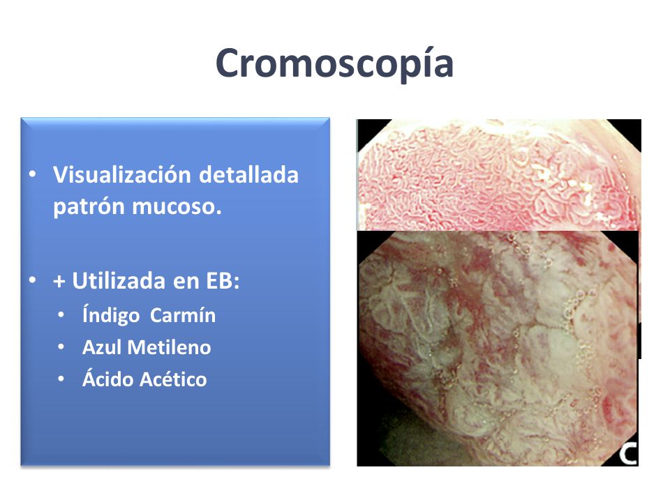 Cromoscopía Visualización detallada patrón mucoso. + Utilizada en EB: