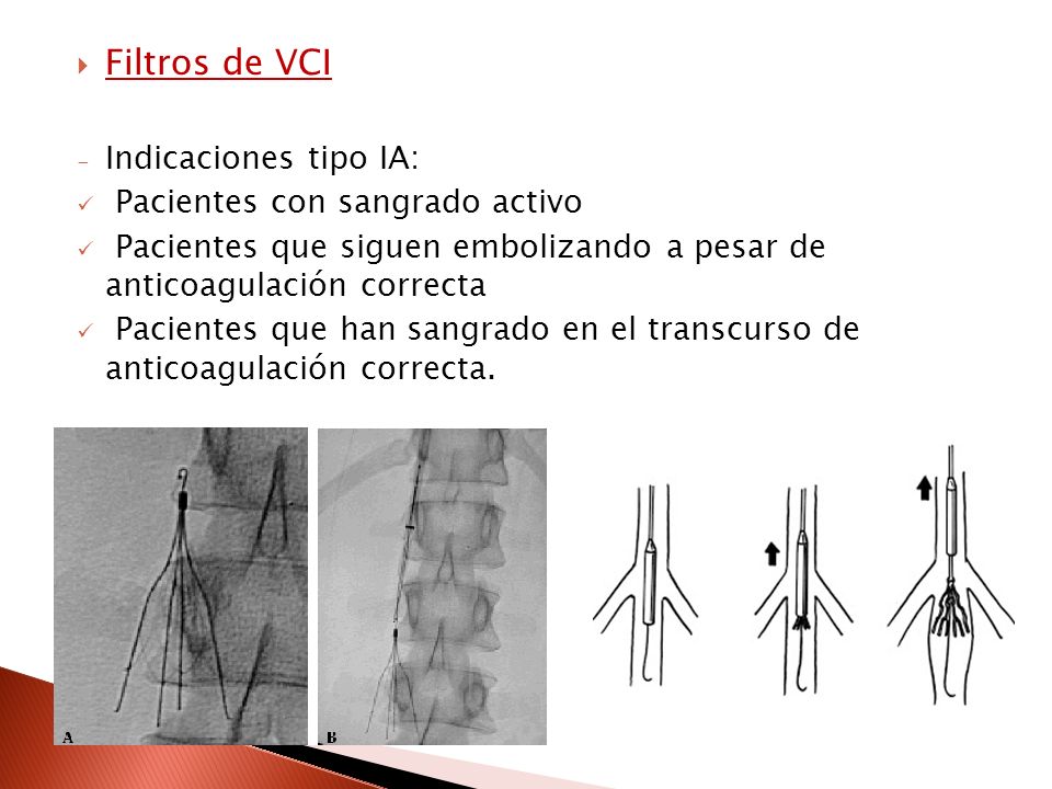 Filtros de VCI Indicaciones tipo IA: Pacientes con sangrado activo