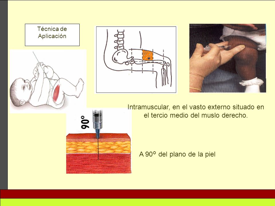 Técnica de Aplicación Intramuscular, en el vasto externo situado en el tercio medio del muslo derecho.