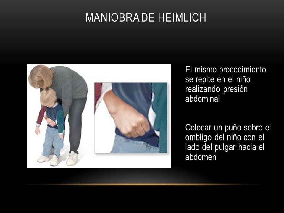 Maniobra de Heimlich El mismo procedimiento se repite en el niño realizando presión abdominal.