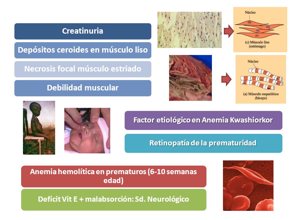 Factor etiológico en Anemia Kwashiorkor Retinopatía de la prematuridad