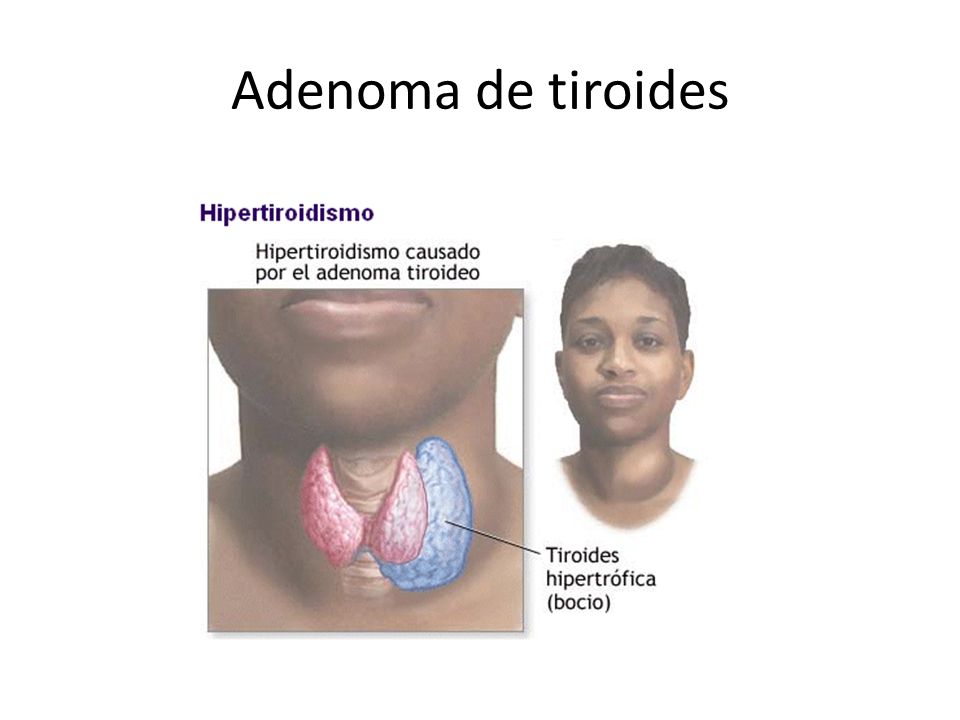 Adenoma de tiroides