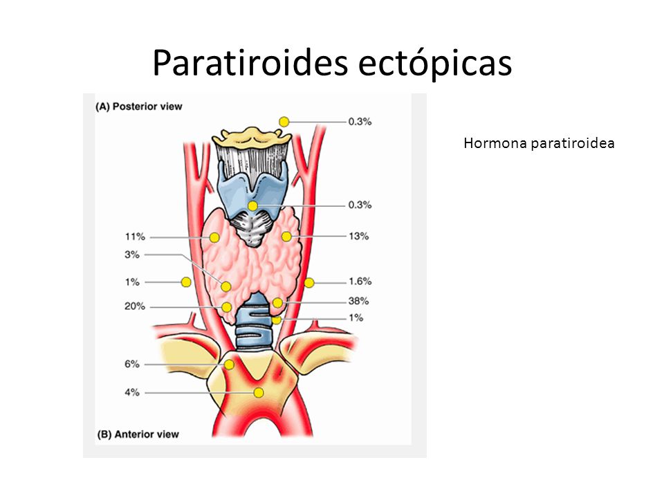 Paratiroides ectópicas