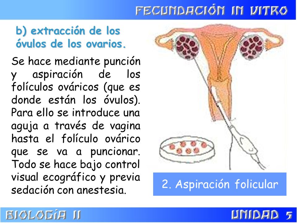 2. Aspiración folicular b) extracción de los óvulos de los ovarios.