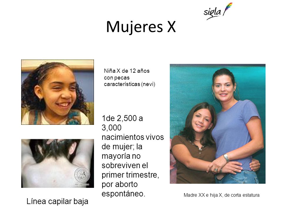 Mujeres X Niña X de 12 años con pecas características (nevi)