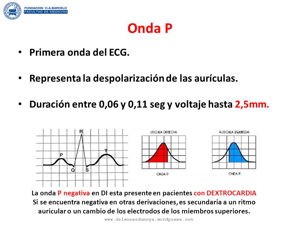 La onda P negativa en DI esta presente en pacientes con DEXTROCARDIA