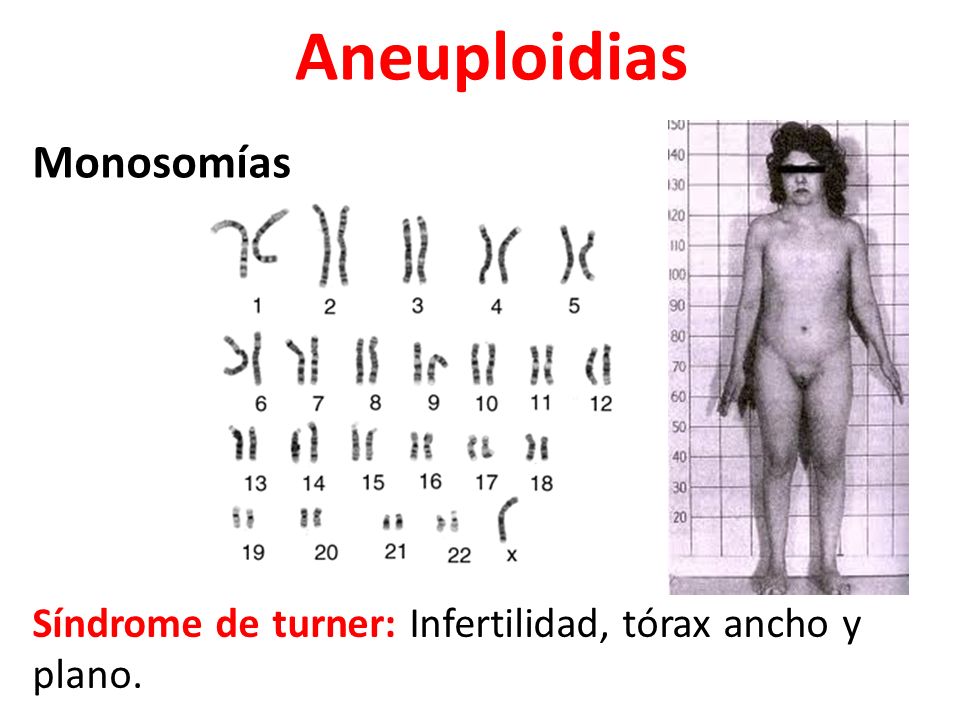 Aneuploidias Monosomías
