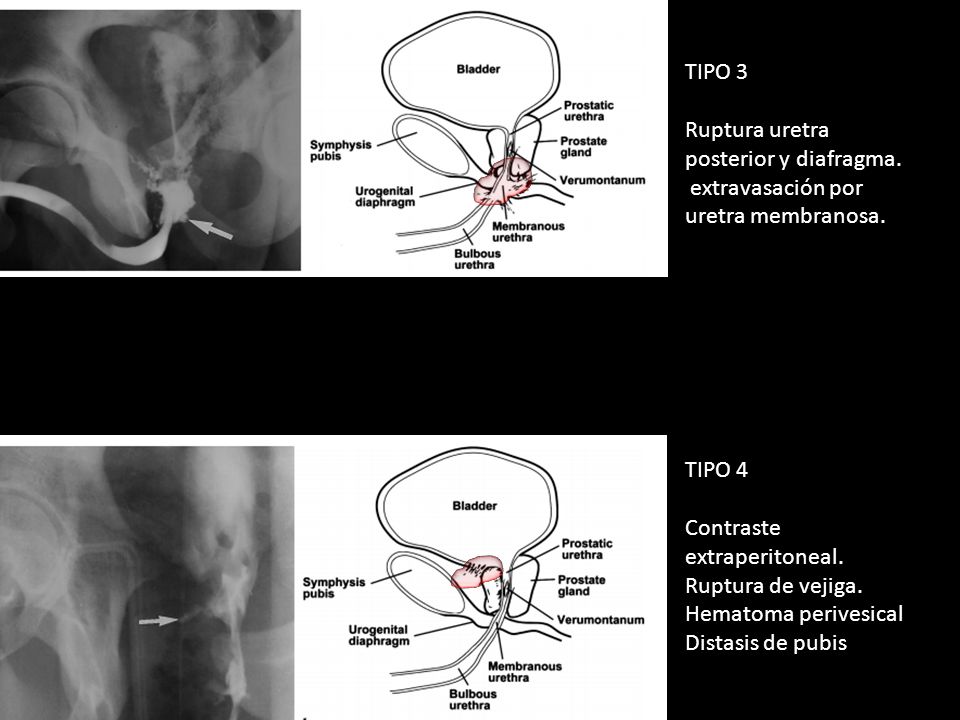 TIPO 3 Ruptura uretra posterior y diafragma. extravasación por uretra membranosa. TIPO 4. Contraste extraperitoneal.