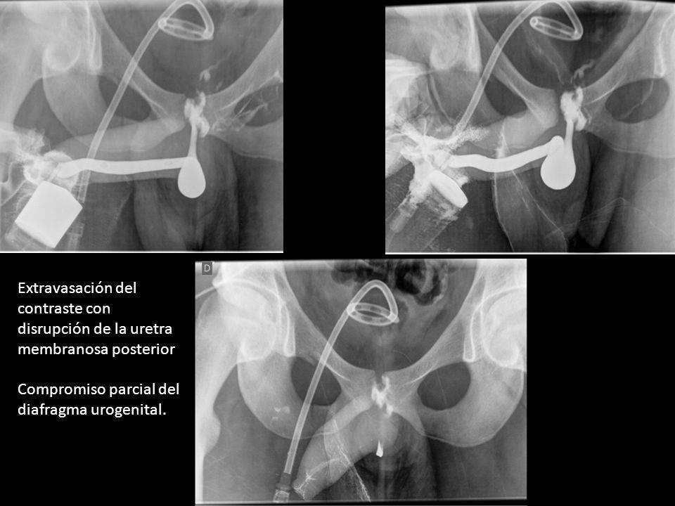 Extravasación del contraste con disrupción de la uretra membranosa posterior