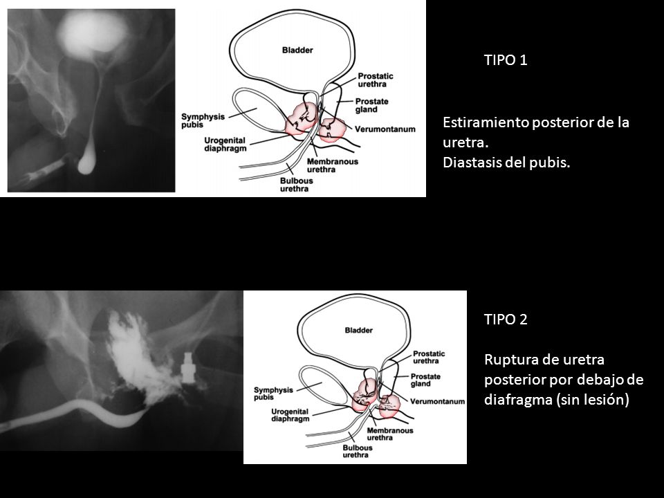 TIPO 1 Estiramiento posterior de la uretra. Diastasis del pubis.