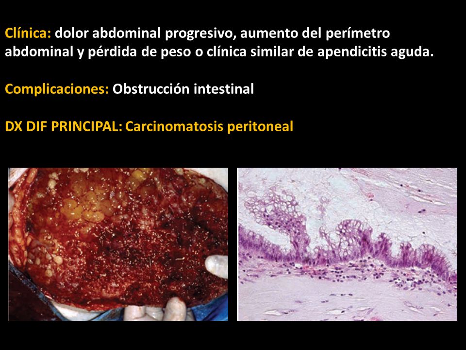 Clínica: dolor abdominal progresivo, aumento del perímetro abdominal y pérdida de peso o clínica similar de apendicitis aguda.